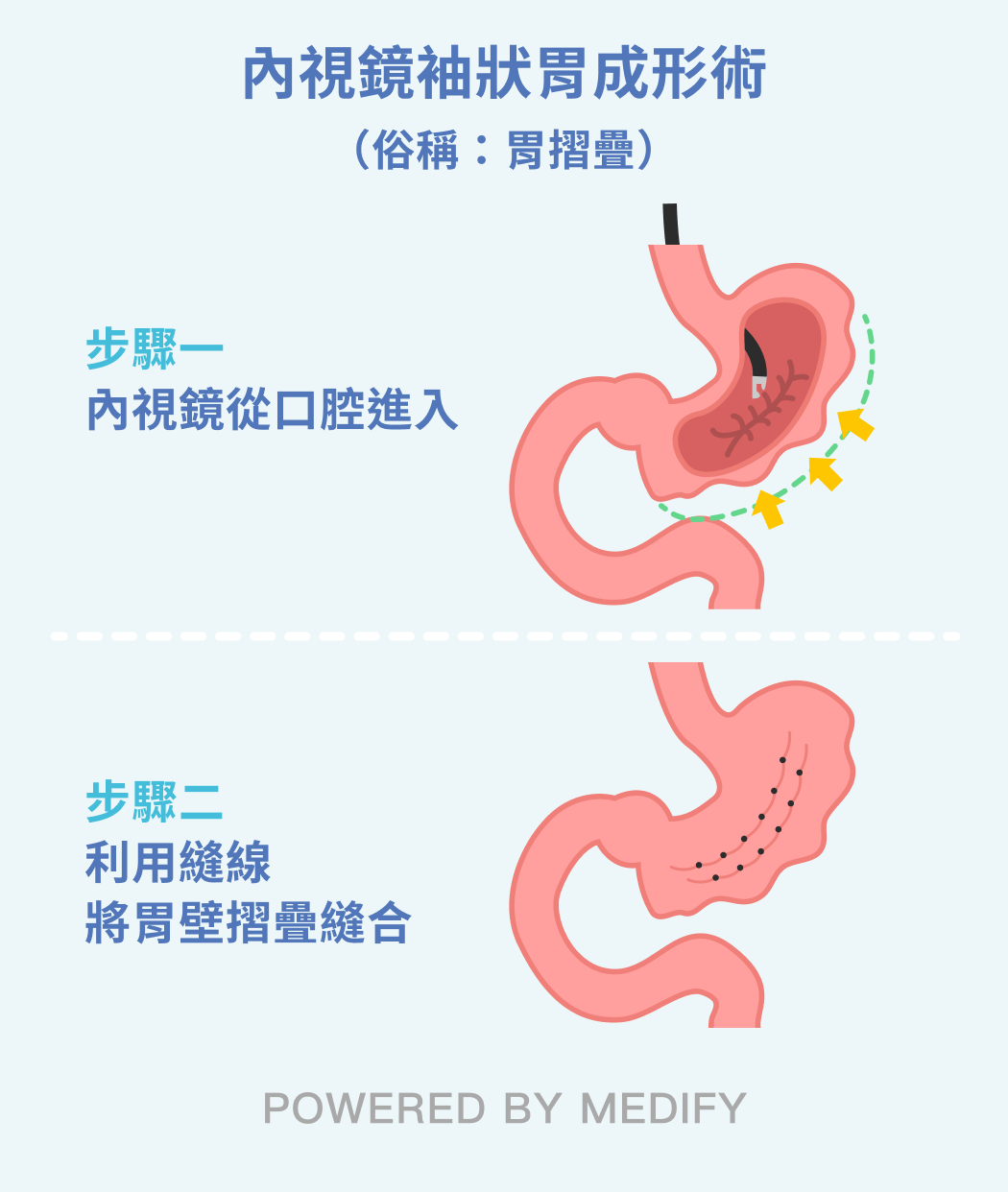 內視鏡袖狀胃成形術