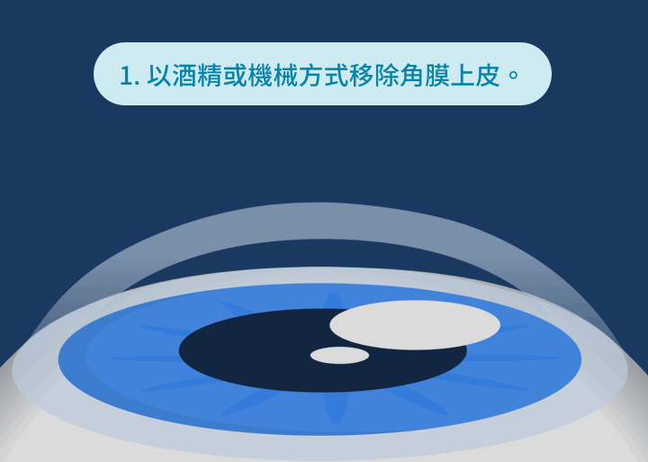 PRK 雷射手術原理